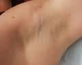 Laser Hair Removal  Armpit After Photo
