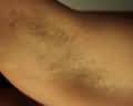 Laser Hair Removal  Armpit Before Photo