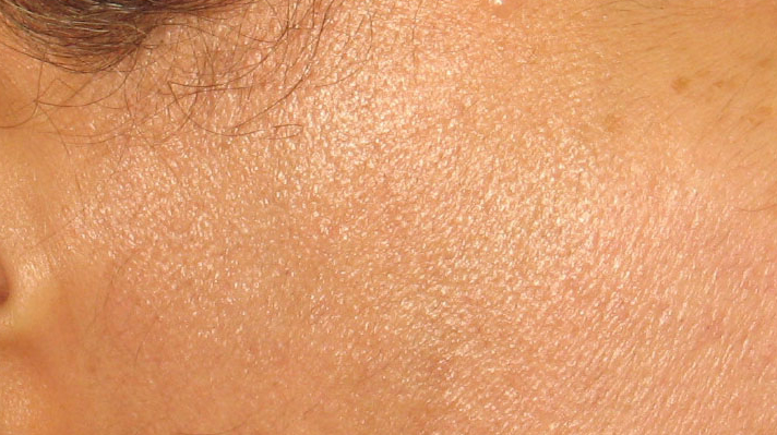 Laser Hair Removal After