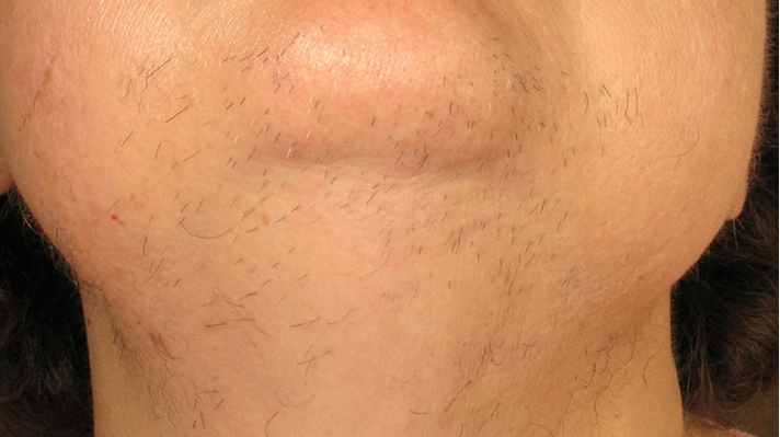 Laser Hair Removal before