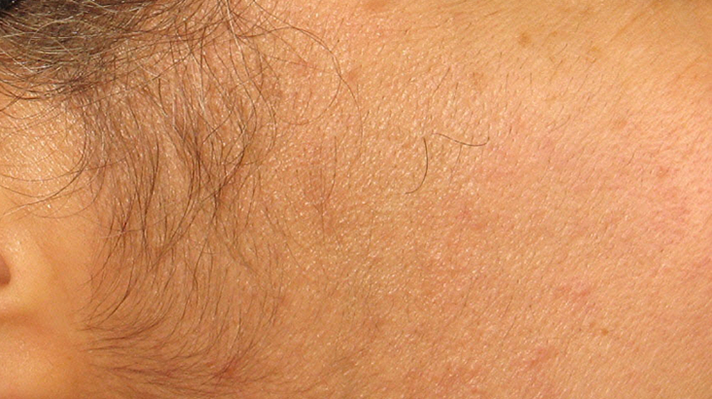 Laser Hair Removal Before